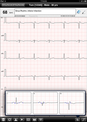 Wireless ECG Machine