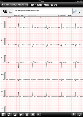 Wireless ECG Machine